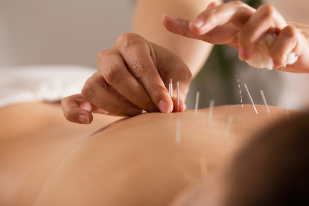 Dry Needling vs. Acupuncture: What’s Best for Pain Relief in Boise?